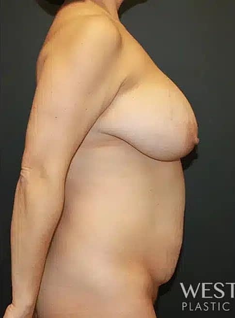 Breast Reduction Before & After