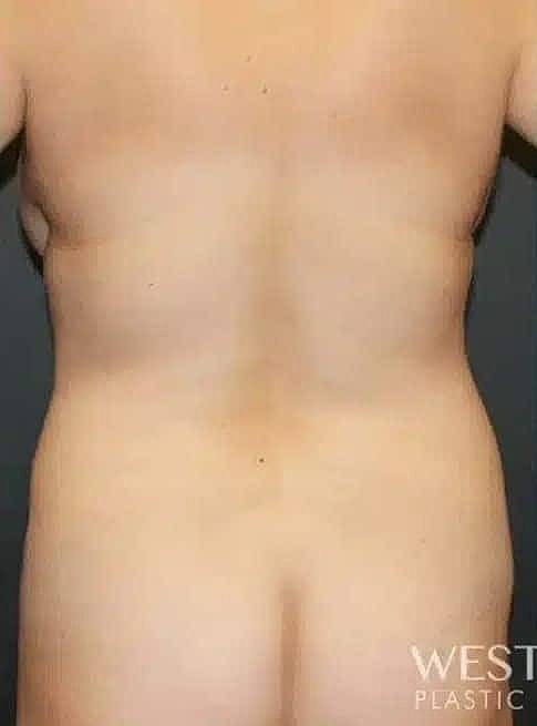 Breast Reduction Before & After