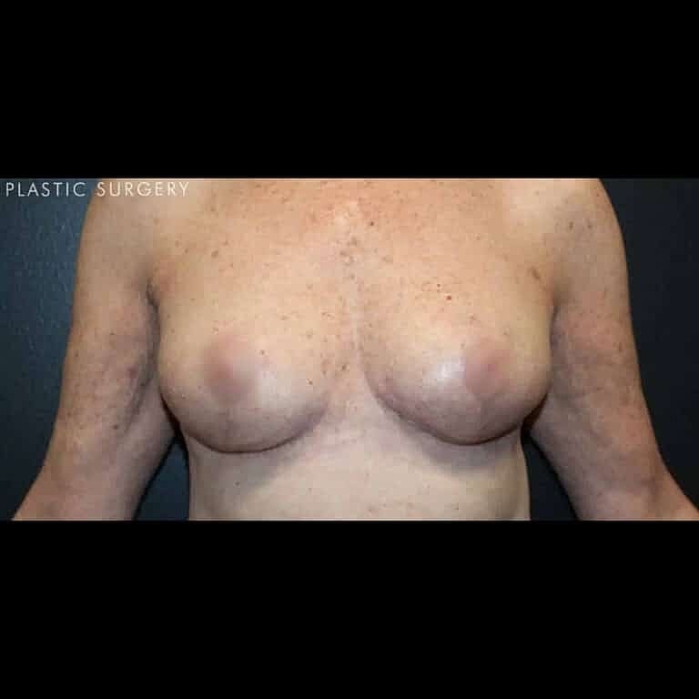 Breast Reduction Before & After