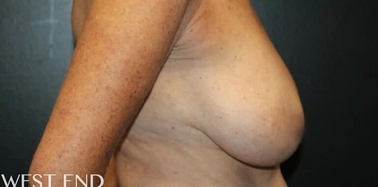 Breast Reduction Before & After
