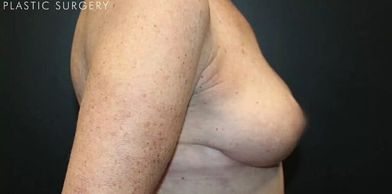 Breast Reduction Before & After