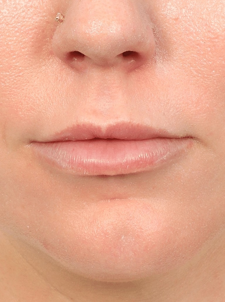 Lip Lift Before & After