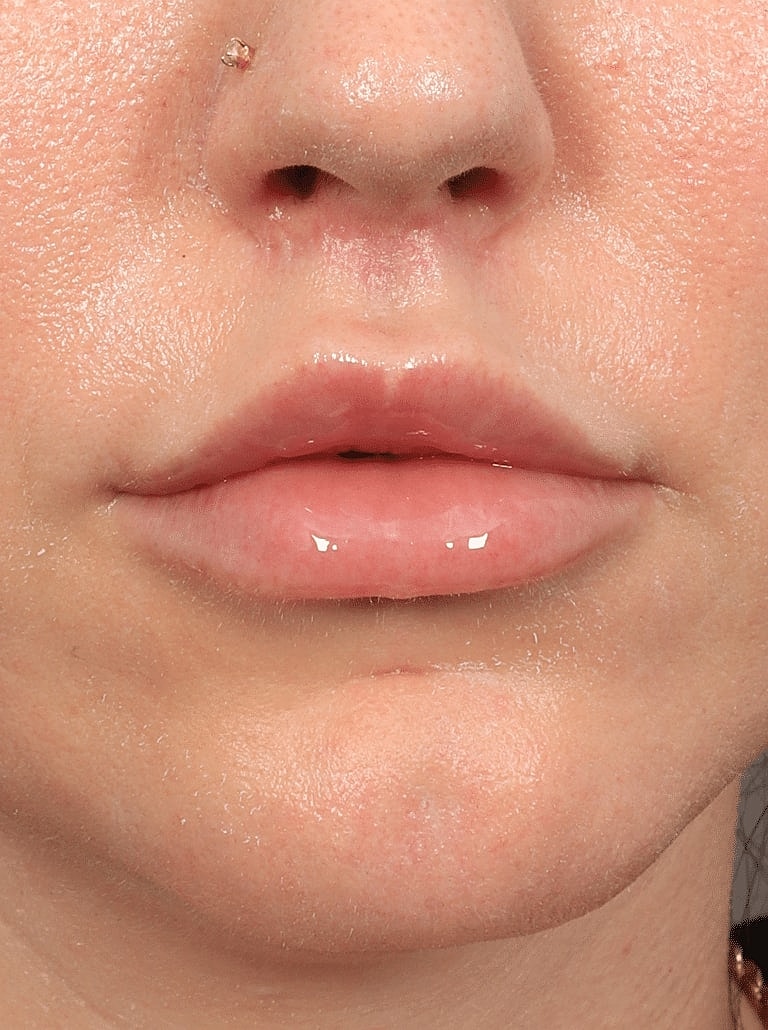 Lip Lift Before & After