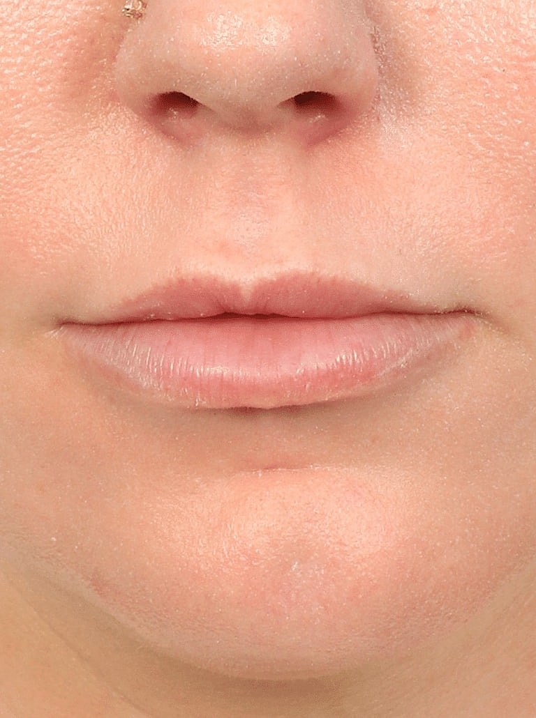 Lip Lift Before & After