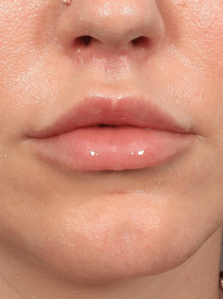Lip Lift Before & After