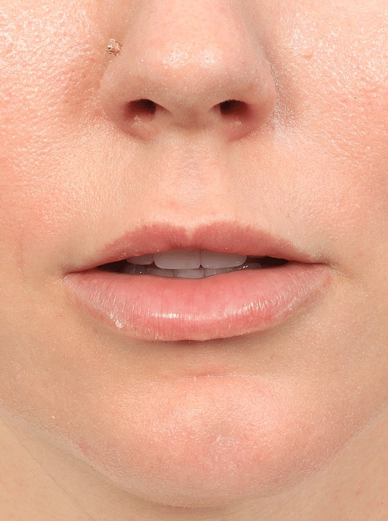 Lip Lift Before & After