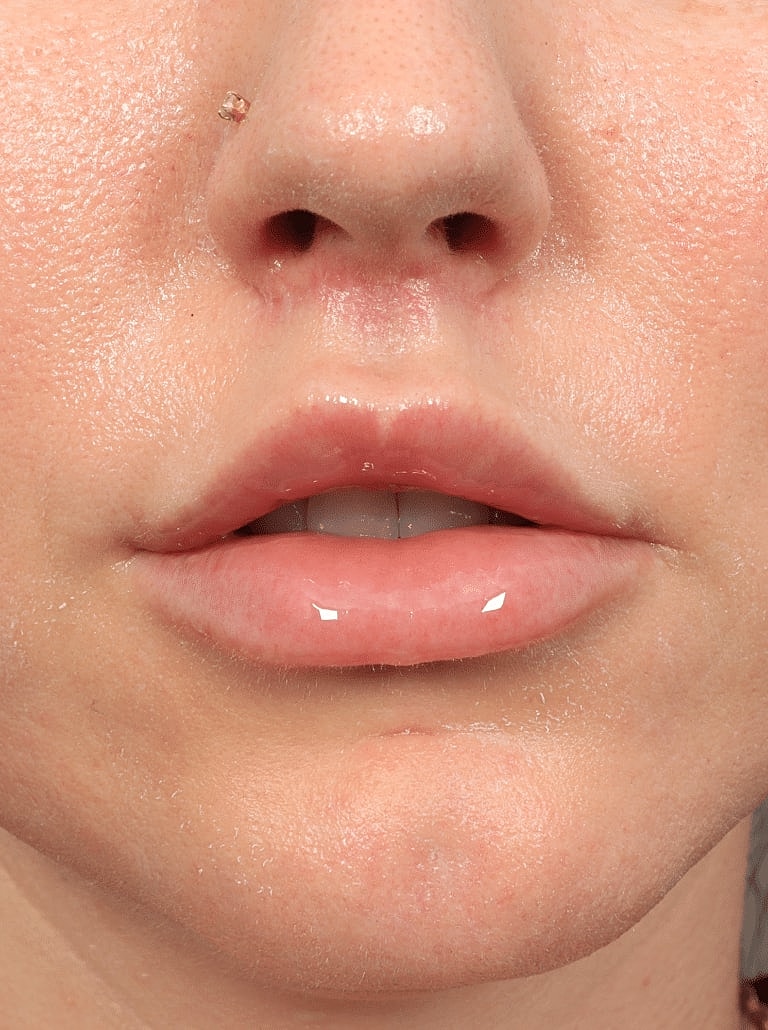 Lip Lift Before & After