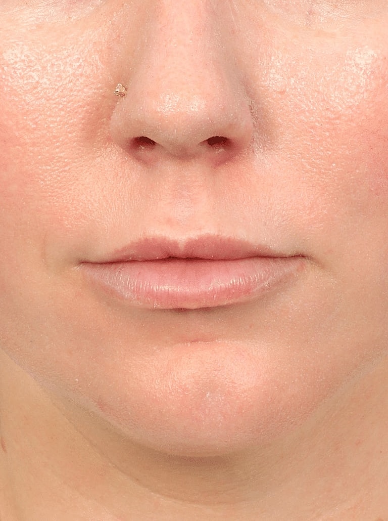 Lip Lift Before & After