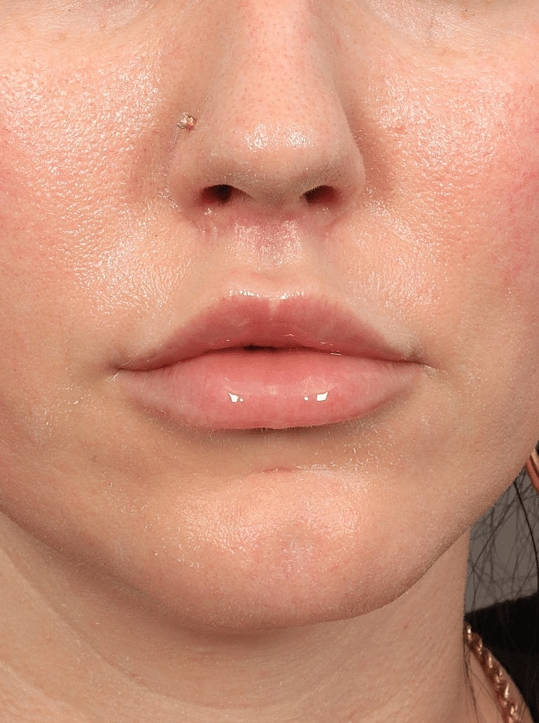 Lip Lift Before & After