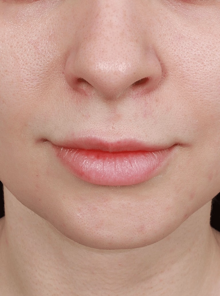 Lip Lift Before & After