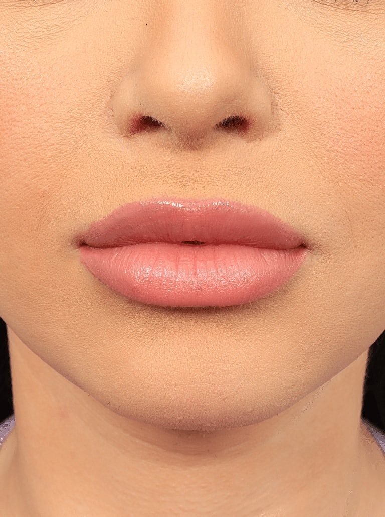 Lip Lift Before & After