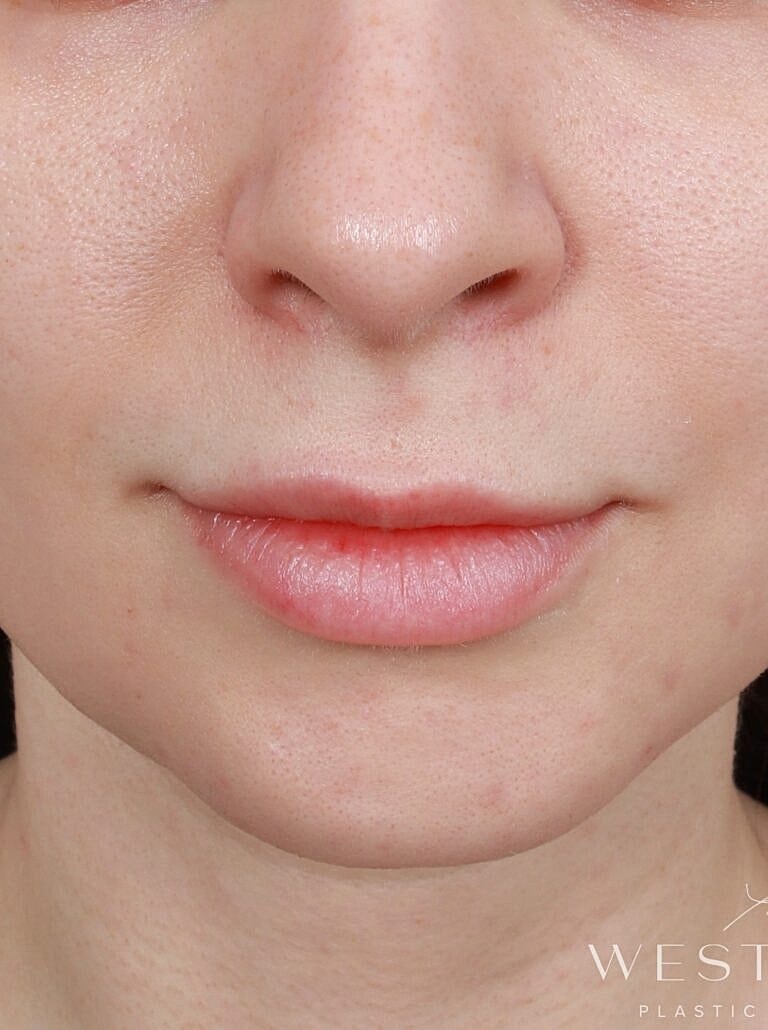 Lip Lift Before & After