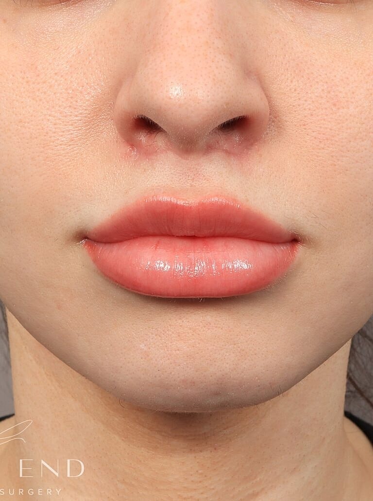 Lip Lift Before & After