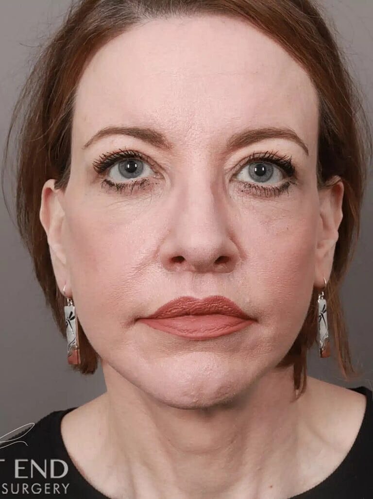 Lip Lift Before & After