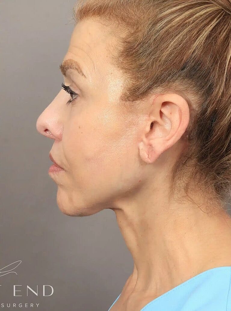 Lip Lift Before & After