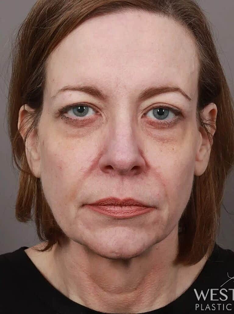 Lip Lift Before & After