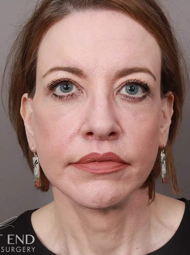 Lip Lift Before & After