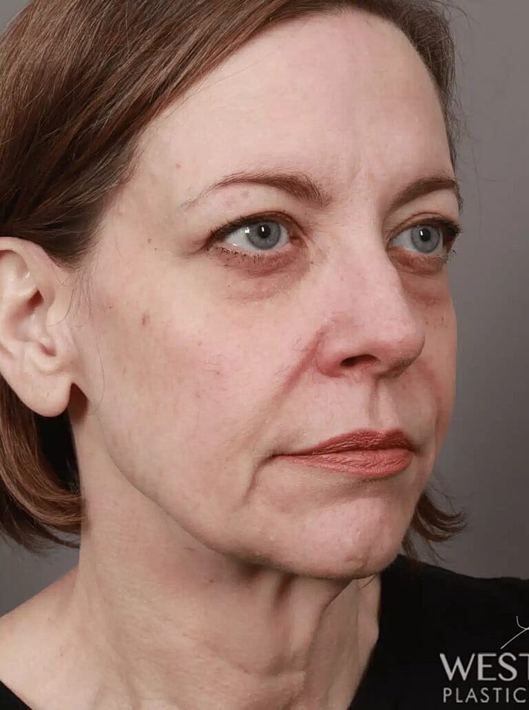 Lip Lift Before & After