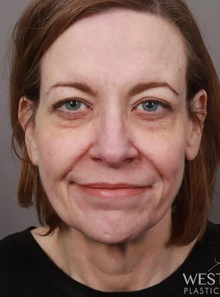 Lip Lift Before & After