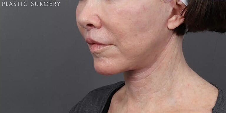 Lip Lift Before & After