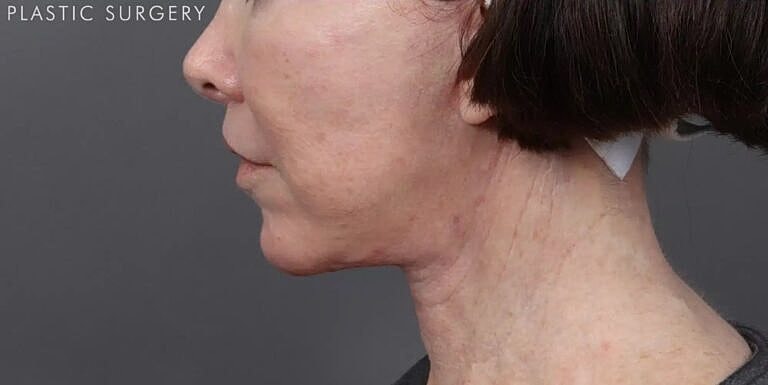 Lip Lift Before & After