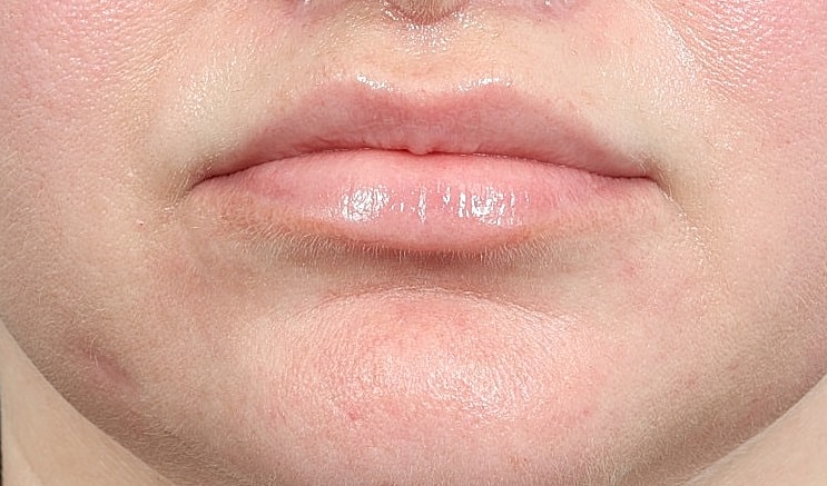 Lip Lift Before & After