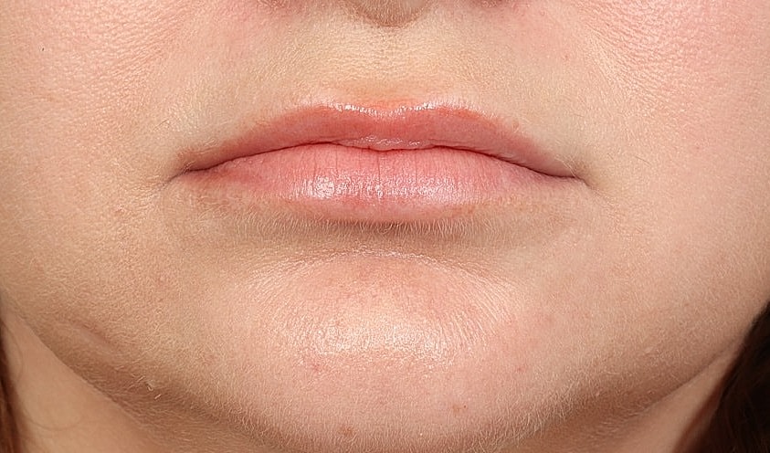 Lip Lift Before & After