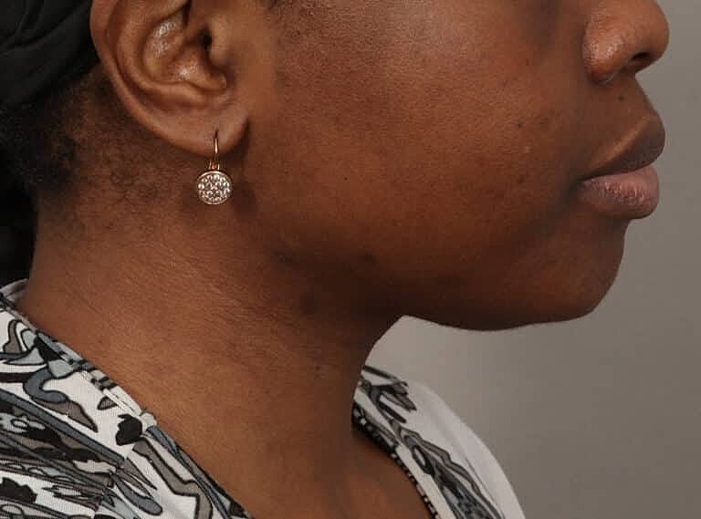 Submentoplasty Before & After