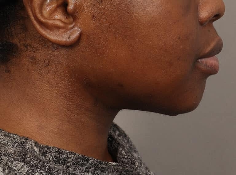 Submentoplasty Before & After