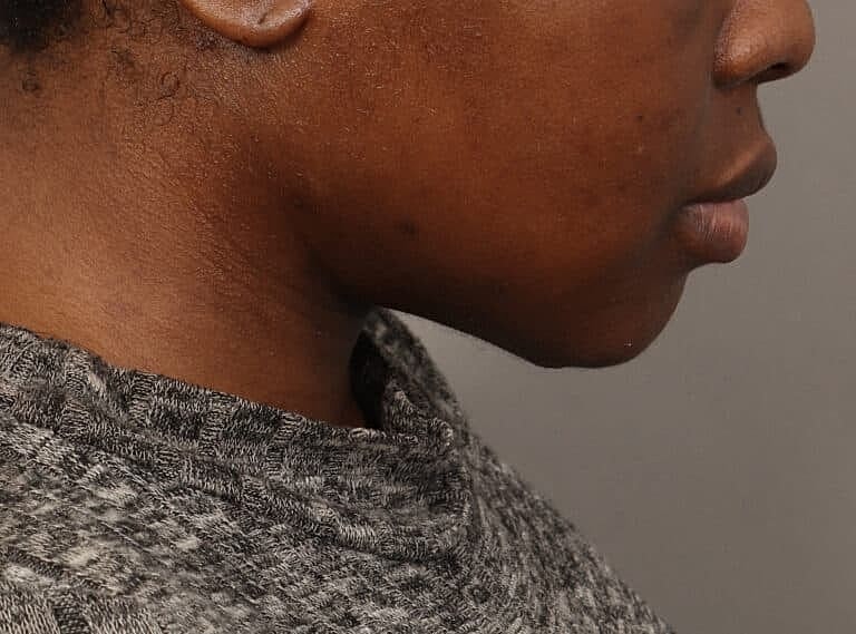 Submentoplasty Before & After