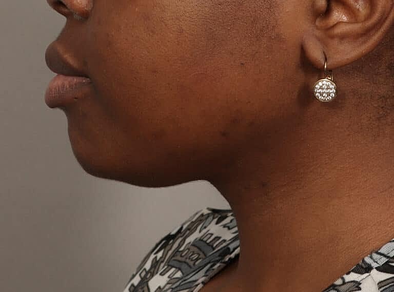 Submentoplasty Before & After