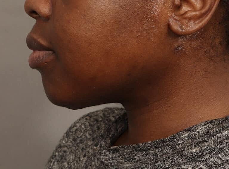 Submentoplasty Before & After