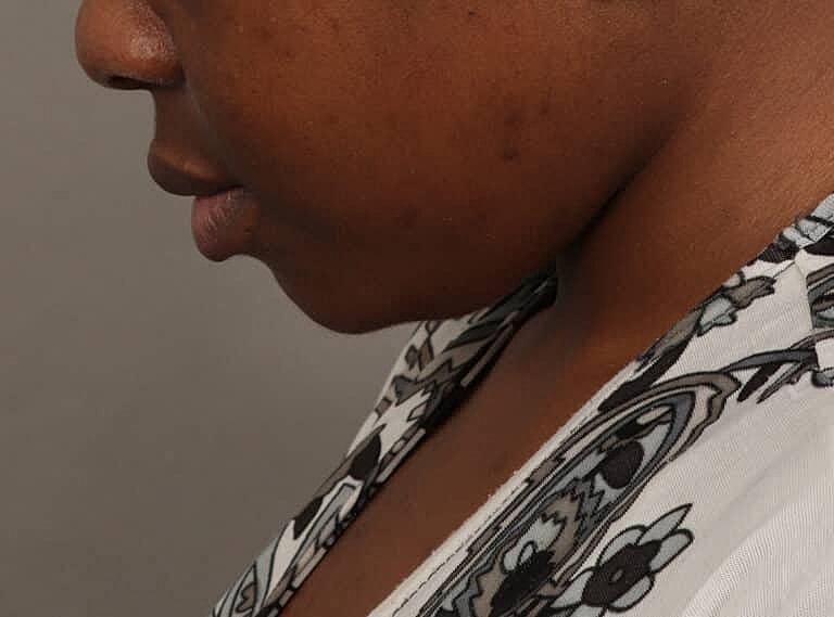 Submentoplasty Before & After