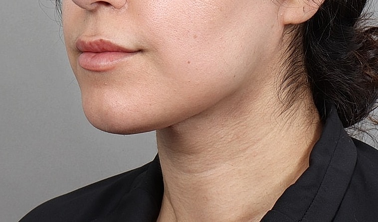 Close-up of woman's jaw and neck area.