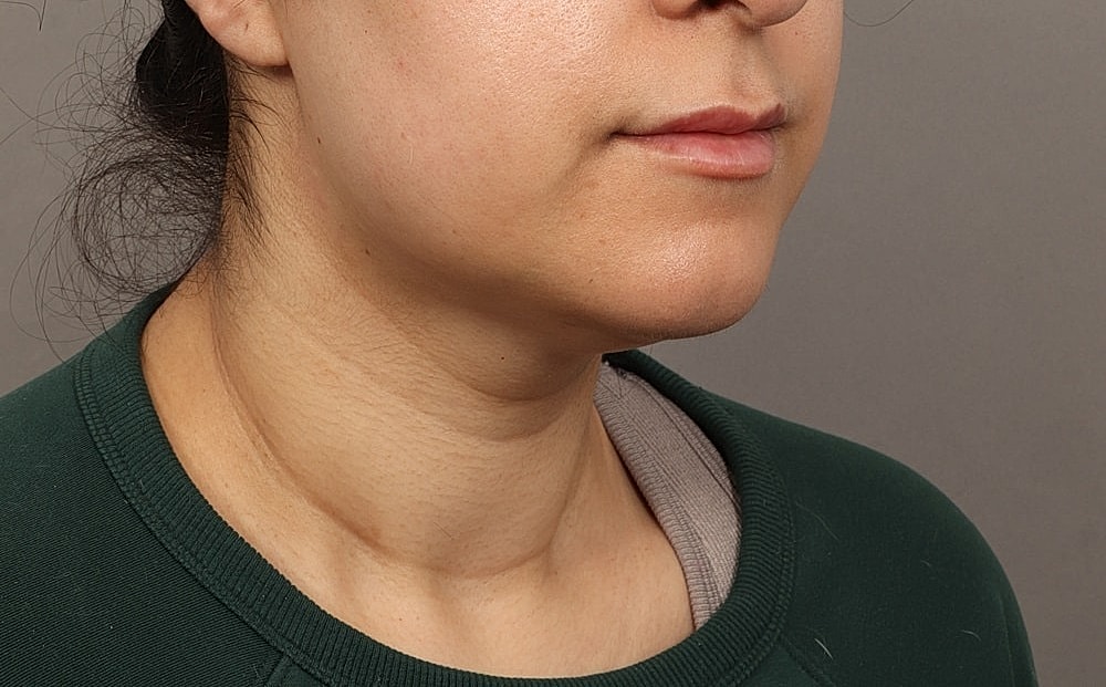 Profile view of a person with neutral expression.