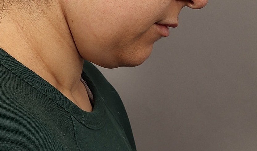 Profile view of a person with chin visible.