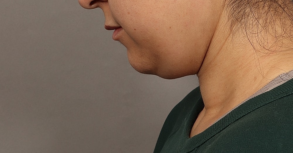 Profile view of a woman’s chin and neck.