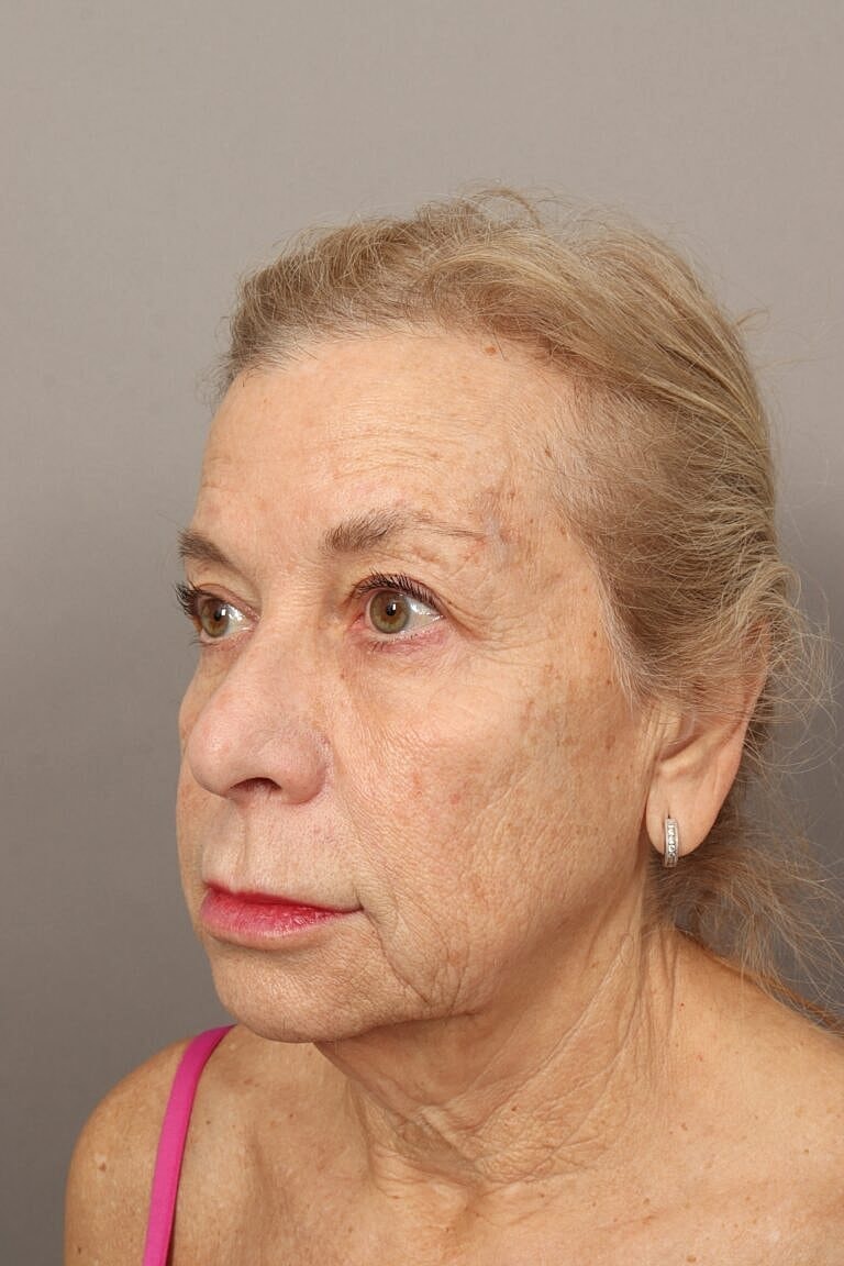 Brow Lift Before & After