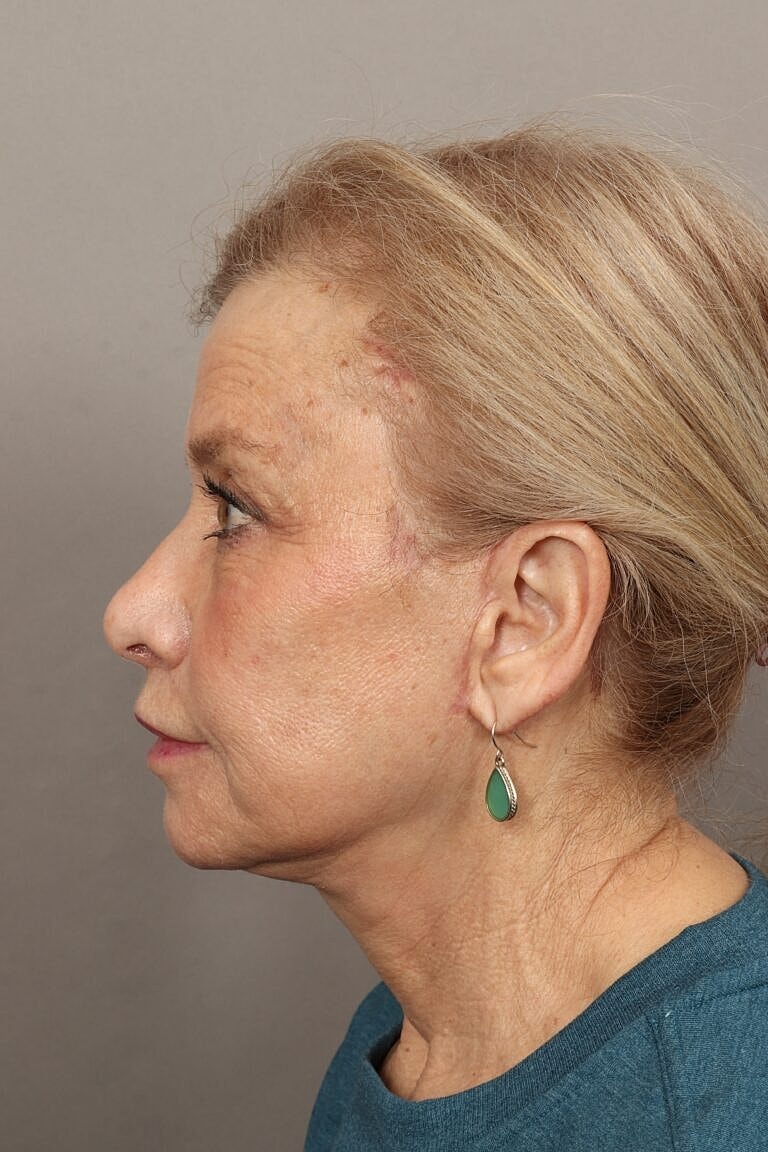 Brow Lift Before & After