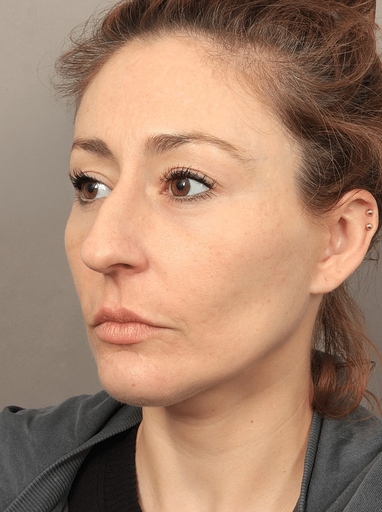 Brow Lift Before & After