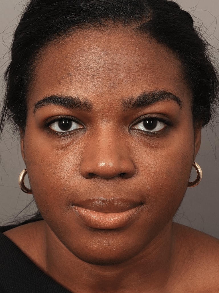 Brow Lift Before & After