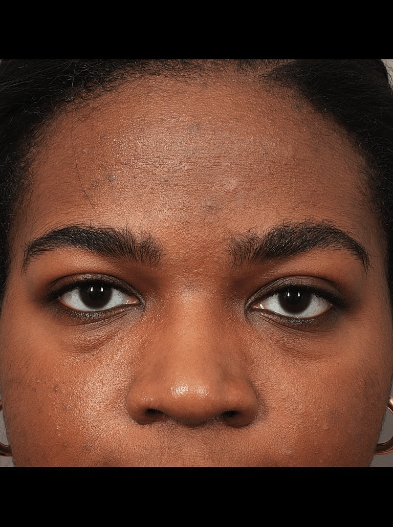 Brow Lift Before & After