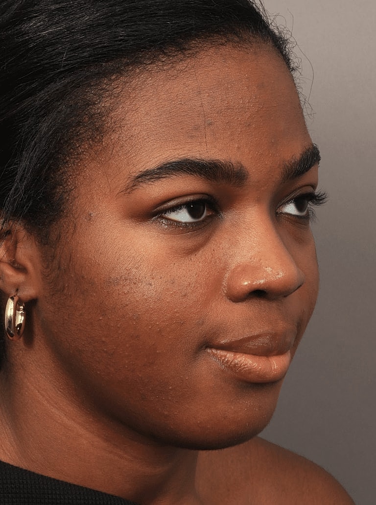 Brow Lift Before & After