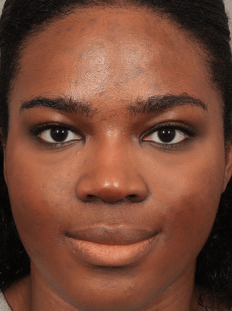 Brow Lift Before & After