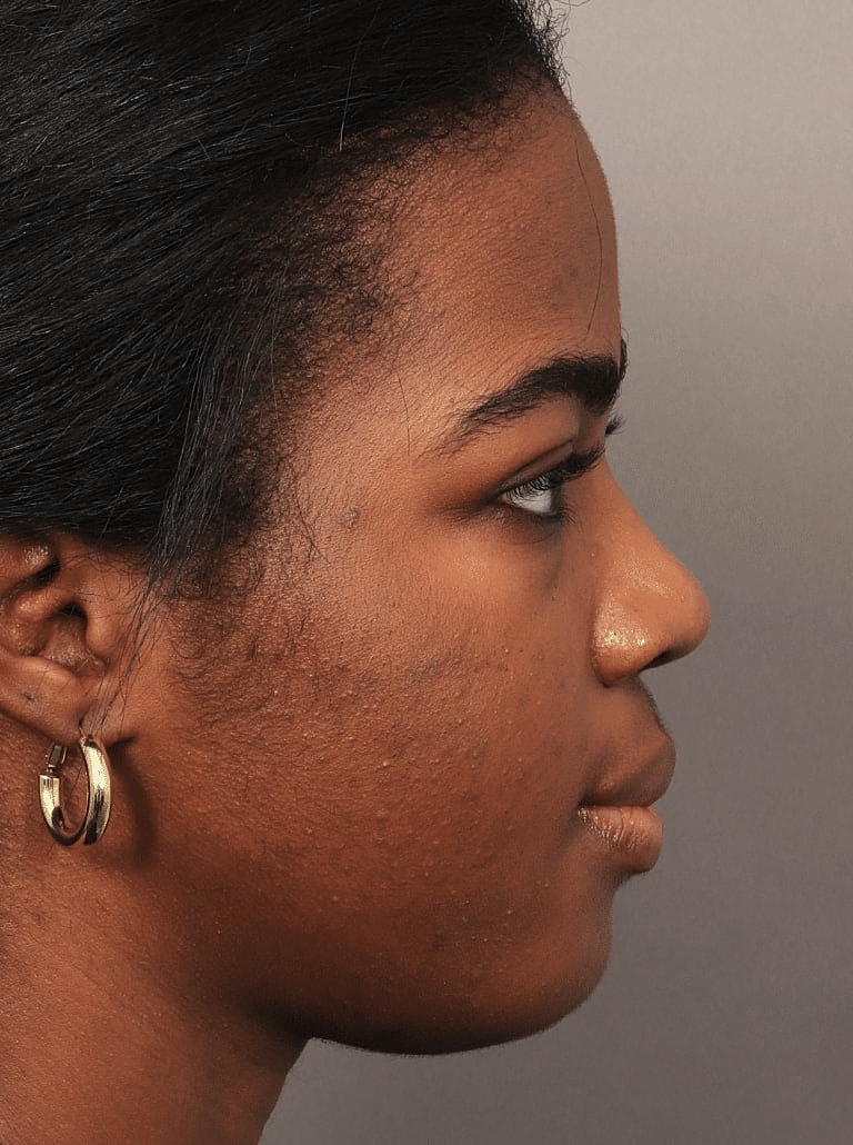 Brow Lift Before & After