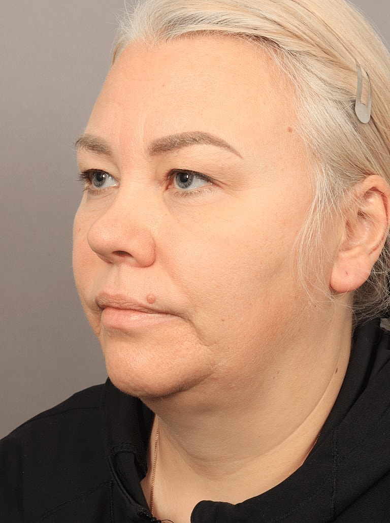 Brow Lift Before & After