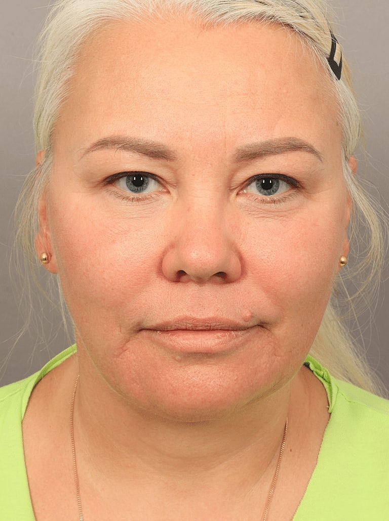 Brow Lift Before & After