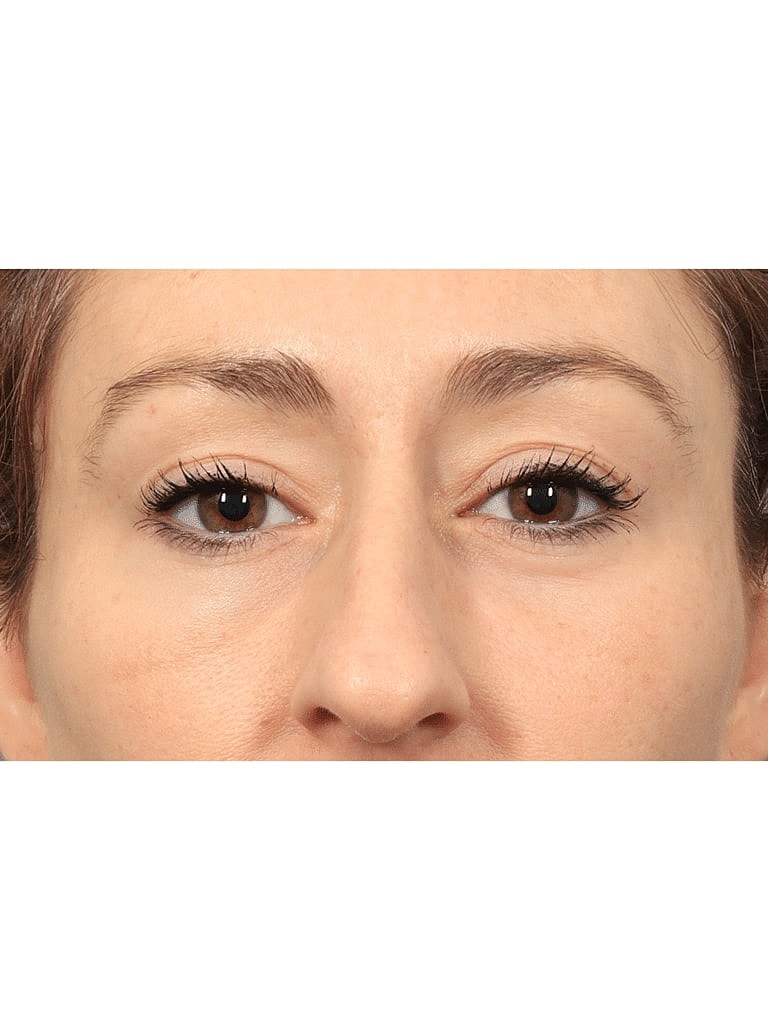Brow Lift Before & After