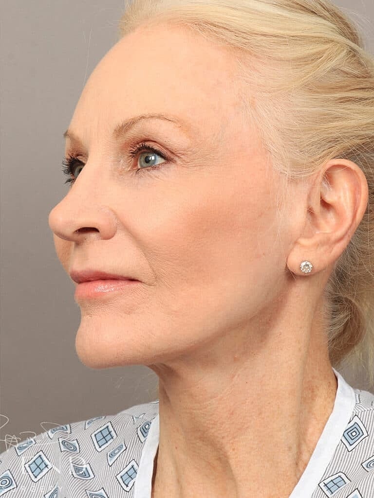 Brow Lift Before & After