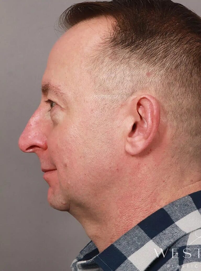 Brow Lift Before & After